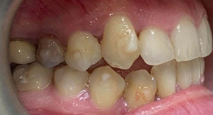 After Braces Treatment Image