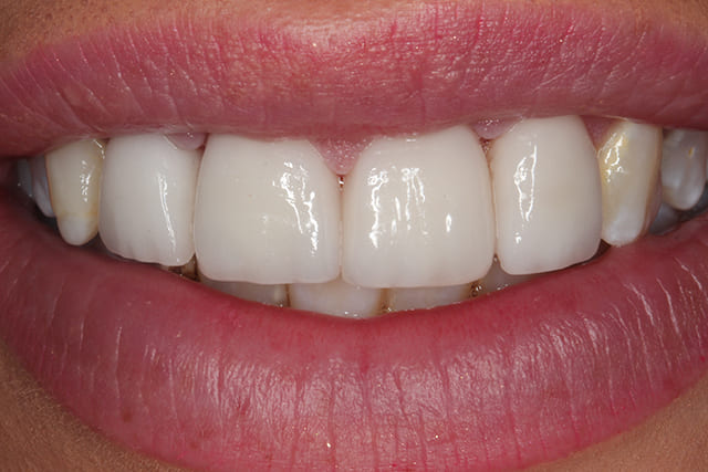 After Porcelain Veneers image