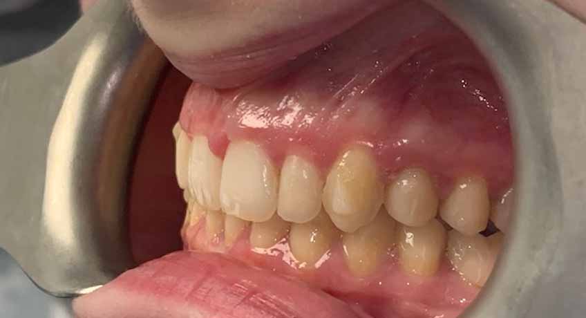 After using Invisalign with Special Offers from Bayswater Dental Clinic