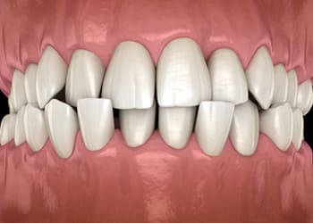 Back or Posterior Cross Bite Image