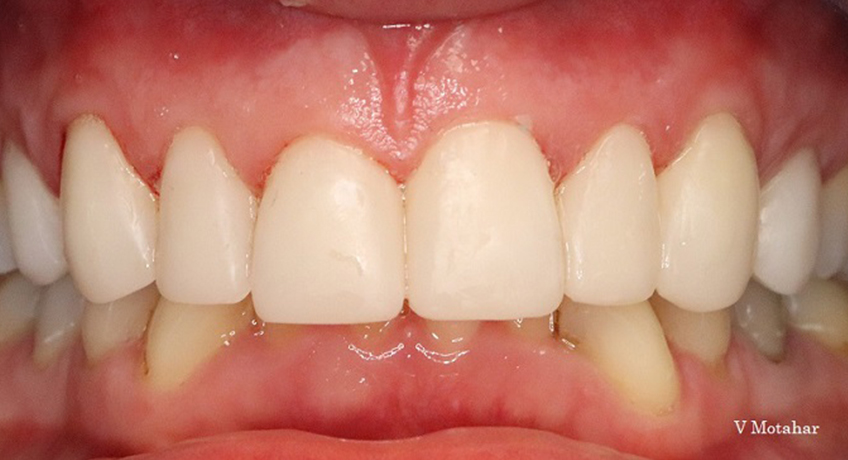 Composite Veneers After 2 Image - Bayswater Dental Clinic