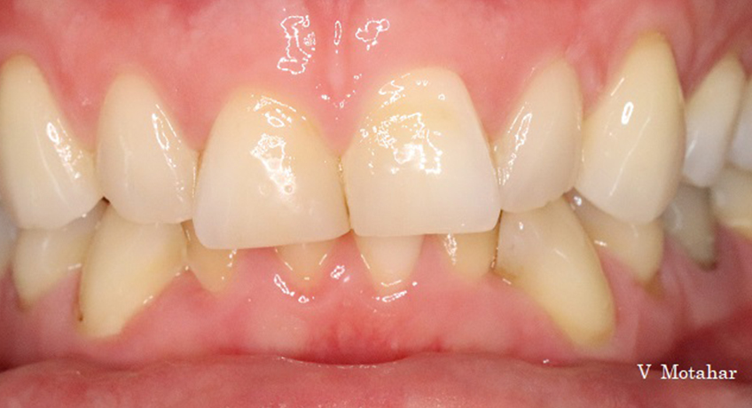 Composite Veneers Before 2 Image - Bayswater Dental Clinic