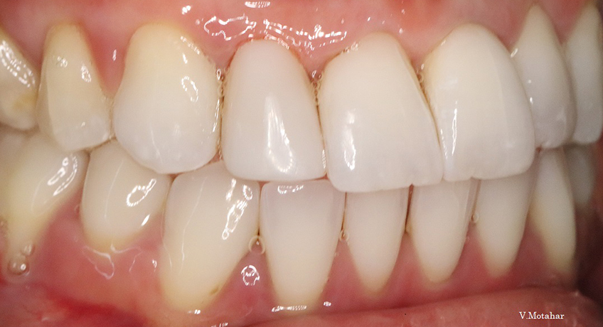 Tag: Composite Veneers After 3 Image - Bayswater Dental Clinic