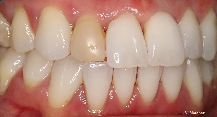 Composite Veneers Before 3 Image - Bayswater Dental Clinic