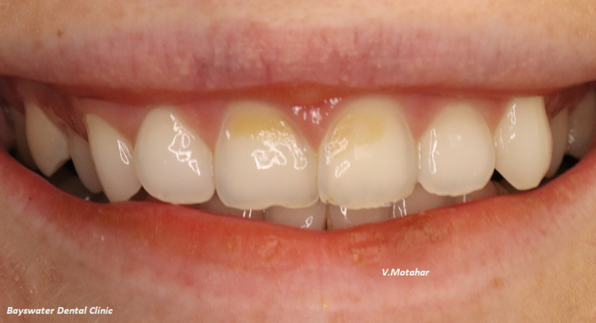 Composite Veneers Before Image - Bayswater Dental Clinic