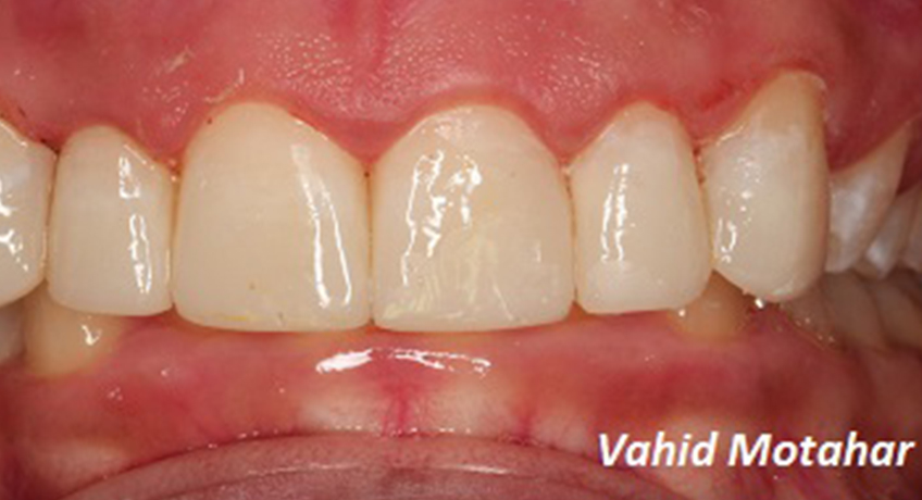 Gum Contouring After 2 Image - Bayswater Dental Clinic