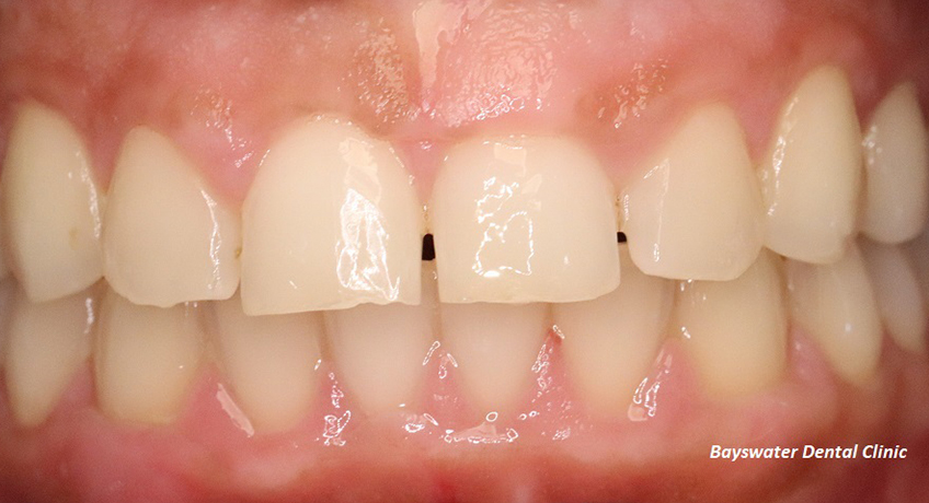 Gum Contouring Before Image - Bayswater Dental Clinic