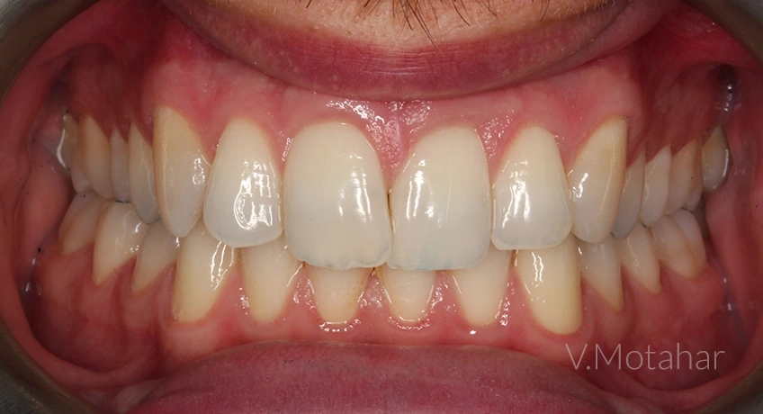 Invisalign i7 Before Image – Bayswater Dental Clinic