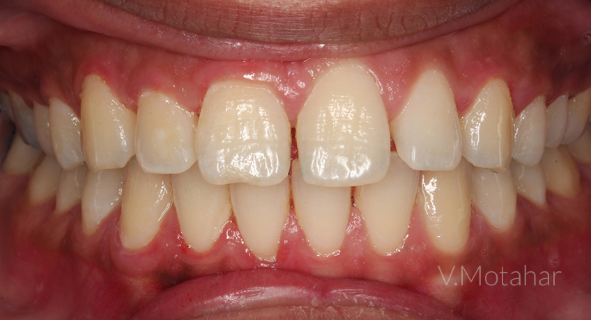 Invisalign Lite 2 Before Image – Bayswater Dental Clinic
