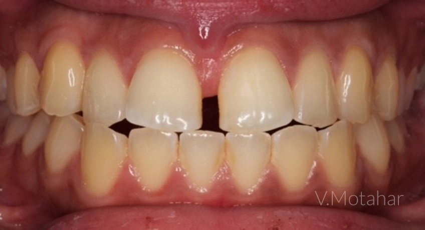 Invisalign Lite Before Image – Bayswater Dental Clinic