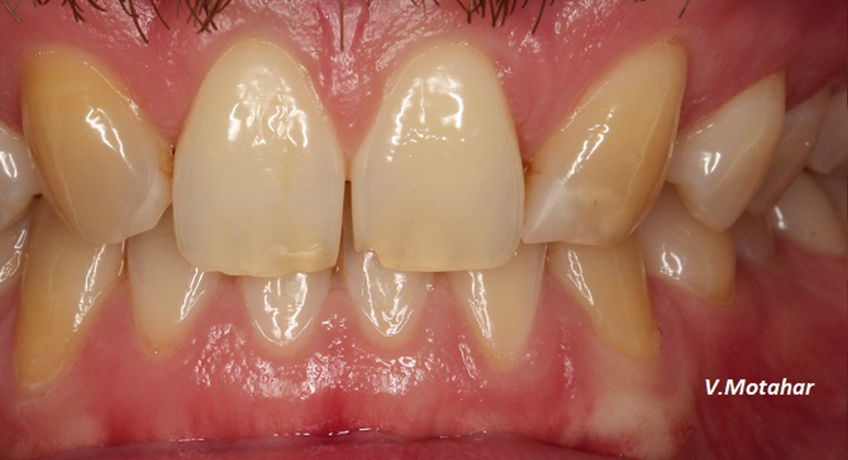 Porcelain Veneers Before Image - Bayswater Dental Clinic
