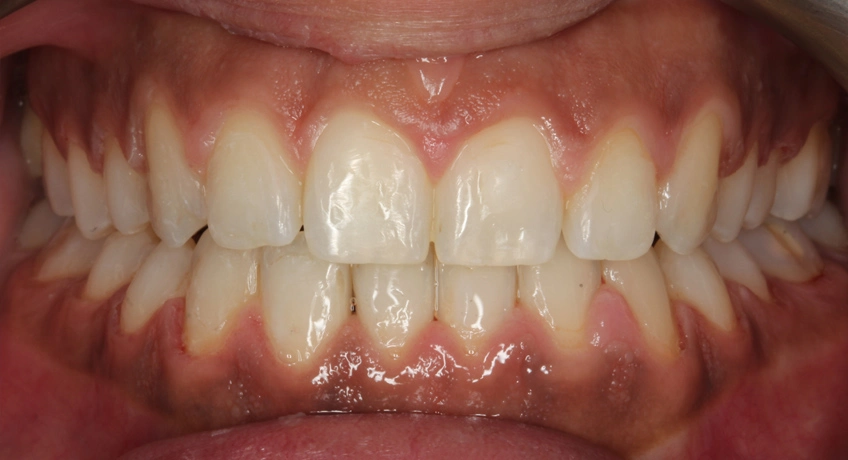 Six Month Smiles After 2 Image - Bayswater Dental Clinic