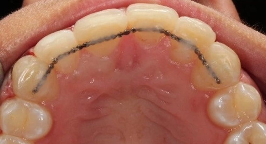 Six Month Smiles After 3 Image - Bayswater Dental Clinic