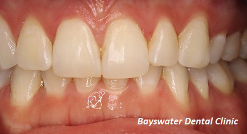 Teeth Whitening Before 2 Image - Bayswater Dental Clinic