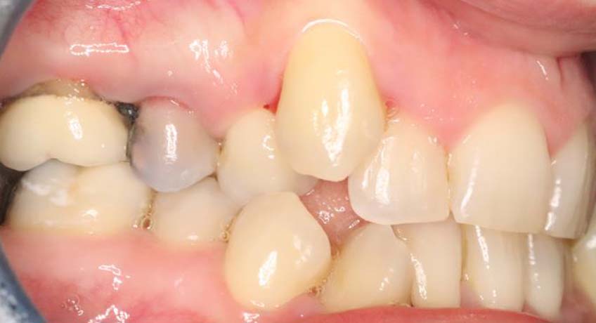 Before Braces Treatment Image