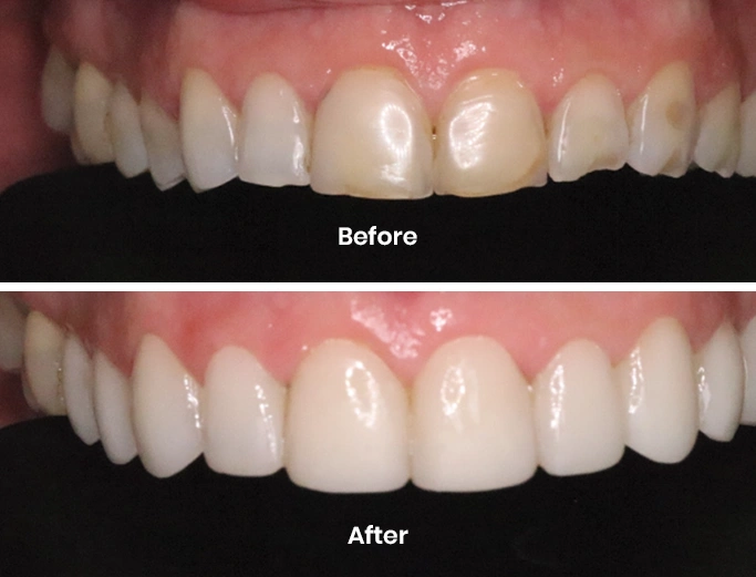 Before composite bonding in dentistry?