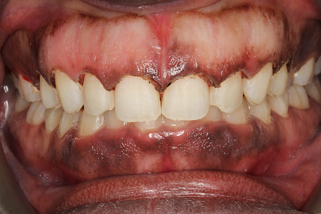 Before Laser Gum Contouring Image 