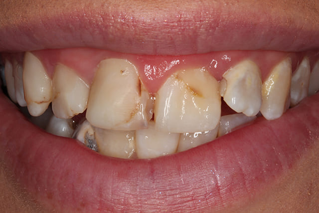 Before Porcelain Veneers image