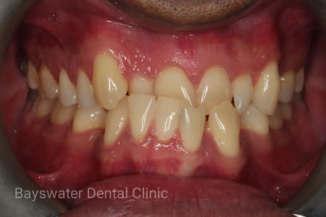 Before using Invisalign from Bayswater Dental Clinic