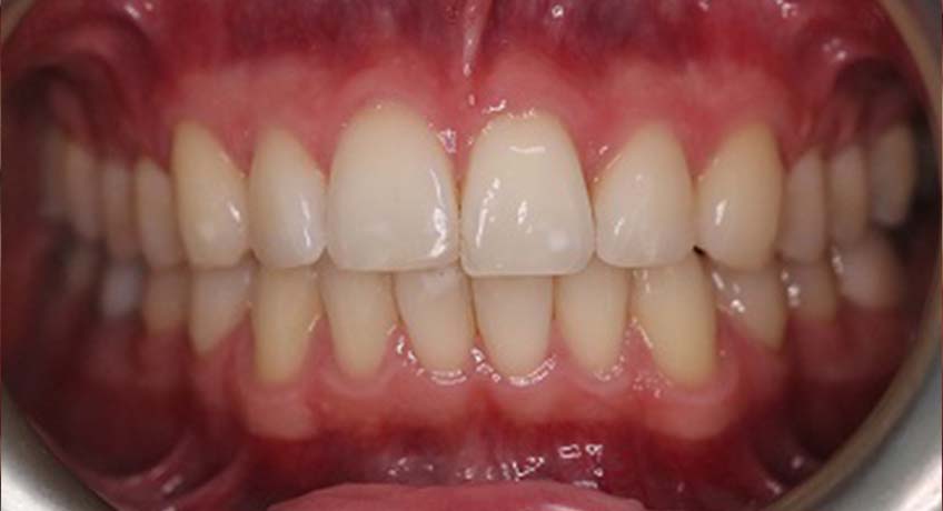Before gating affordable Invisalign treatment from Bayswater Dental Clinic