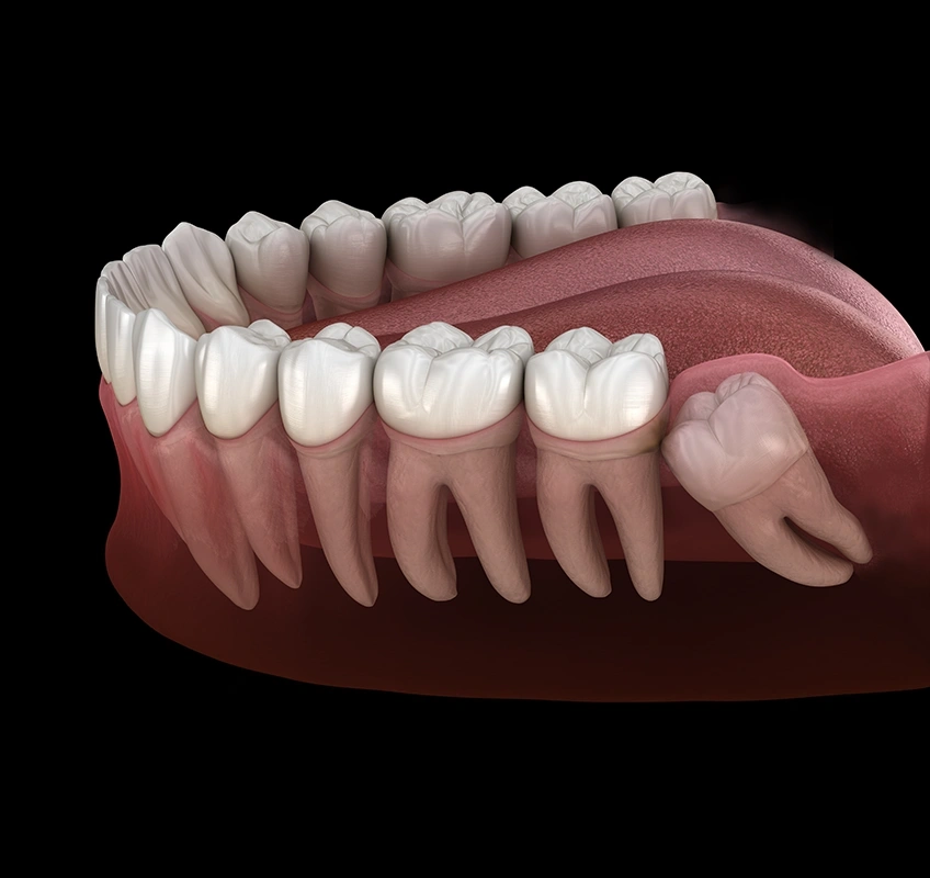 What are the complications of Wisdom teeth removal? – Bayswater Dental Clinic
