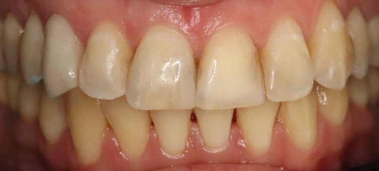 Composite Bonding Before Image