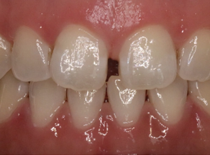 Composite Bonding Treatment Before image