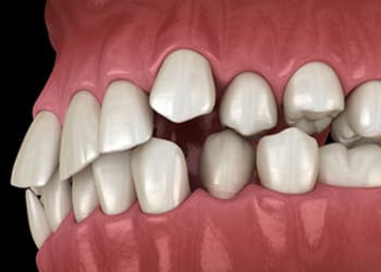 Crowded Teeth image