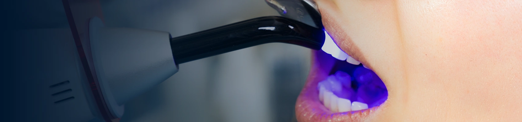 Dental Bonding at Bayswater Dental Clinic banner image