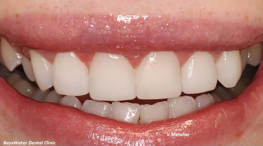 Dental Bonding treatment after- Bayswater Dental Clinic
