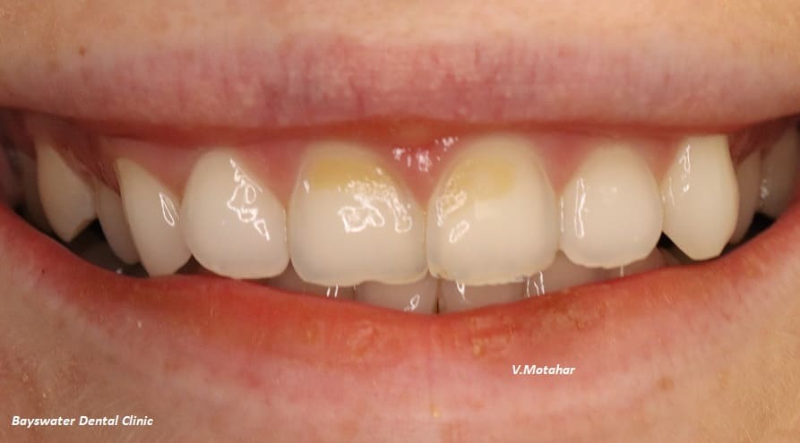 Dental Bonding treatment before - Bayswater Dental Clinic