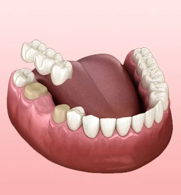 Dental Bridges London - Bayswater Dental Clinic