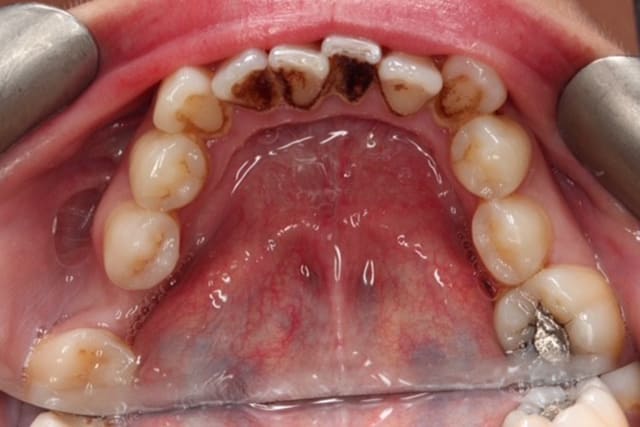 Dental Hygienist service before image – Bayswater Dental Clinic