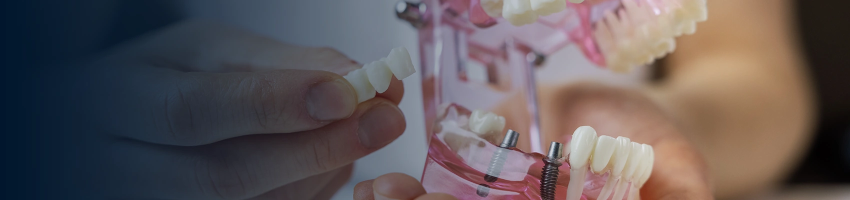 Dental Implants at Bayswater Dental Clinic banner image