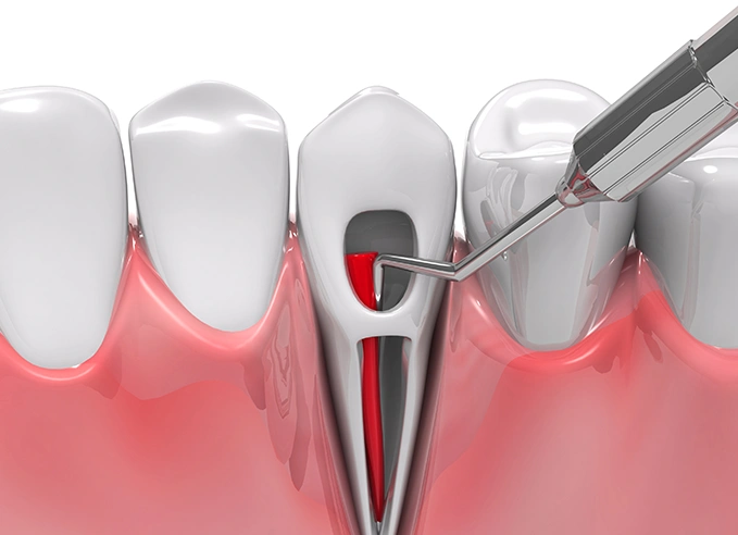 Emergency Root Canal treatment in London by Bayswater Dental Clinic