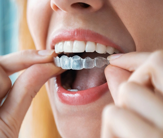 Extra Invisalign fees London Bayswater Dental Clinic