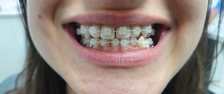 Fixed Invisible Braces in London