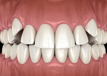 Front Cross Bite Image