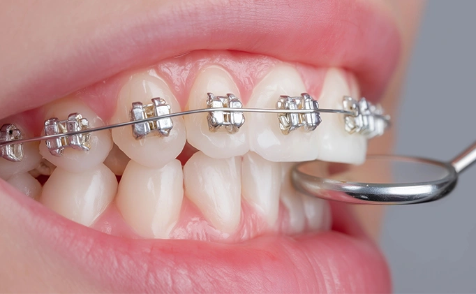 How Do Fixed Braces Work - Explained By Bayswater Dental Clinic
