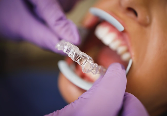 How Do Invisalign Lite Braces Work?