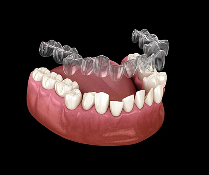 Invisalign limitations and alternative orthodontic options