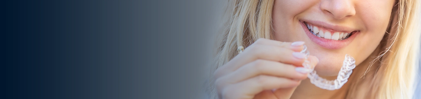 Invisalign lite braces in London – Bayswater Dental Clinic