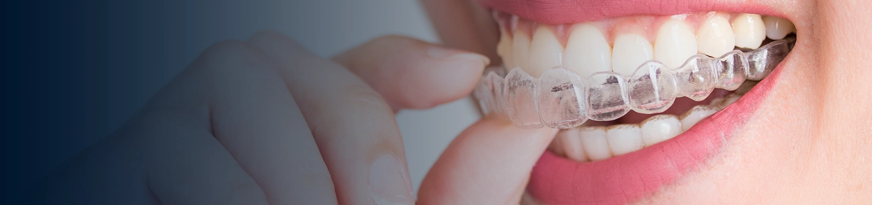 Invisalign Lite at Bayswater Dental Clinic in London banner image