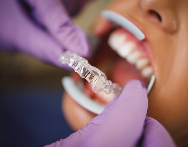 Invisalign Moderate cost in London