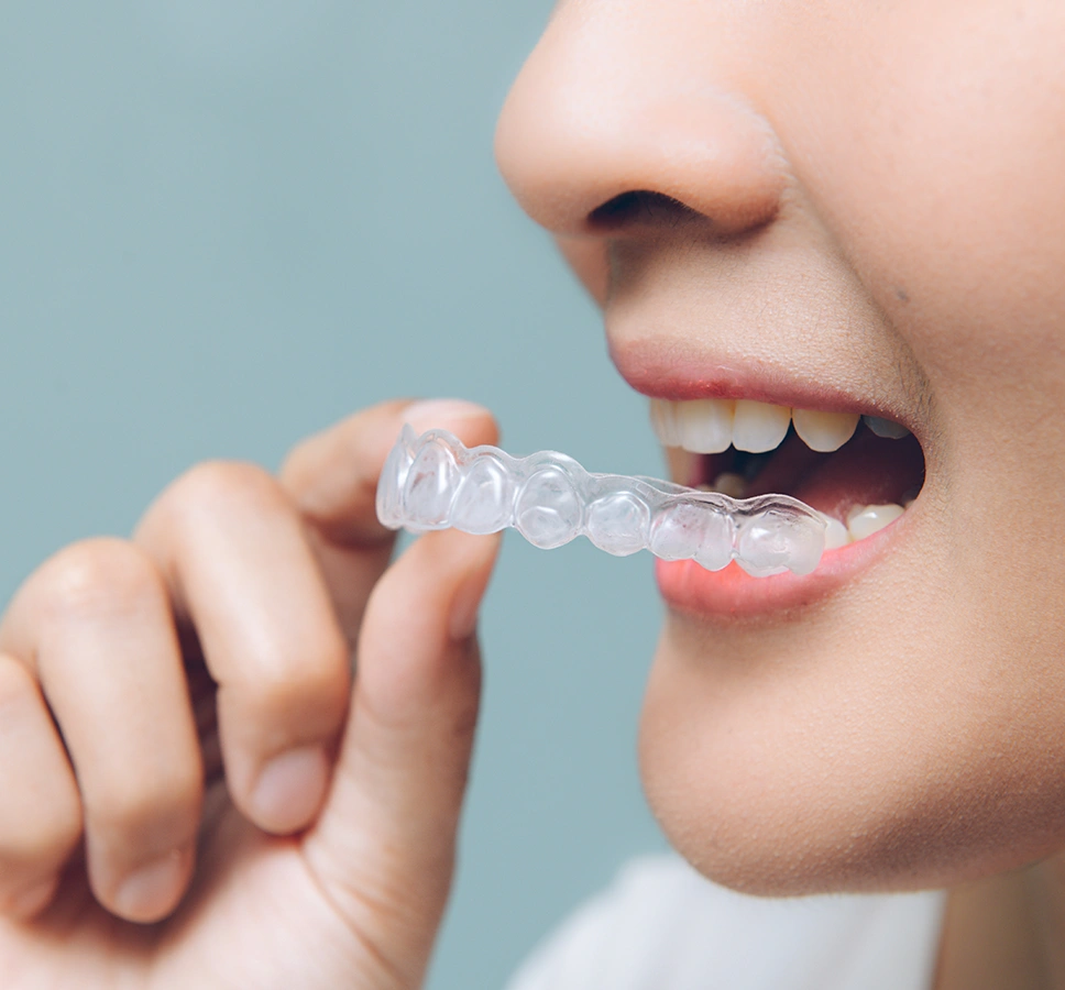 Invisalign Moderate Package Offer in London 
