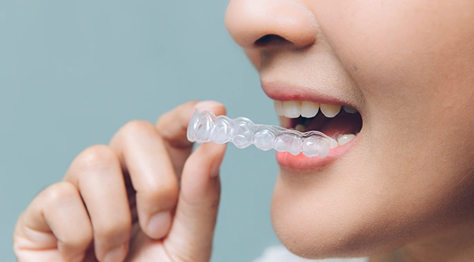 Invisible Ceramic Fixed Braces