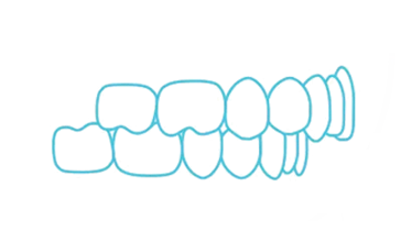 Overjet icon - Bayswater Dental Clinic