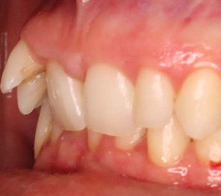 Before composite bonding in dentistry?