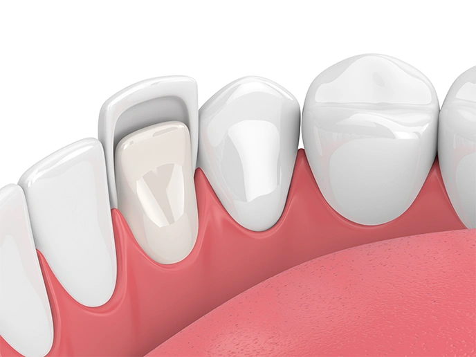 How Long Do the Porcelain Veneers Last - Bayswater Dental Clinic