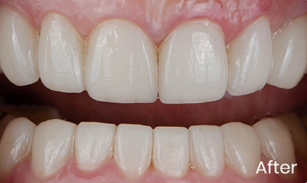 Price on Composite Bonding in london